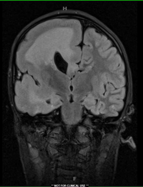 7A3 Hemimegalencephaly (Case 8) FLAIR 3