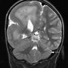 7A4 Hemimegalencephaly & Cross Cerebellar atrophy (Case 8) T2 2