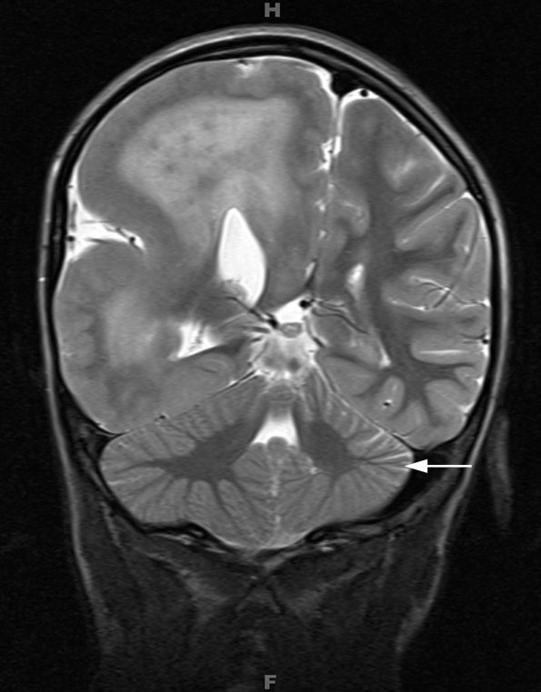 7A4 Hemimegalencephaly & Cross Cerebellar atrophy (Case 8) T2 2