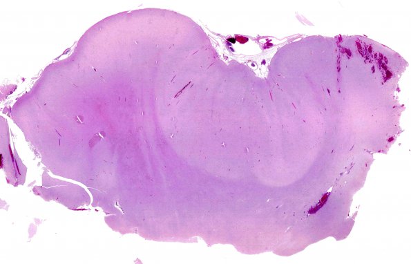 7B Polymicrogyria (Case 8) H&E A5 whole mount