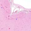 7D Hemimegalencephaly (Case 8) leptomeningeal heterotopia