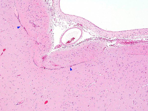 7D Hemimegalencephaly (Case 8) leptomeningeal heterotopia