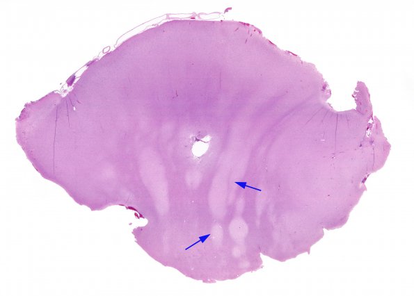 7E1 Hemimegalencephaly (Case 8) H&E B4 whole mount