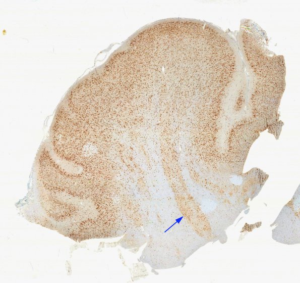 7E2 Polymicrogyria (Case 8) NeuN N B5 whole mount