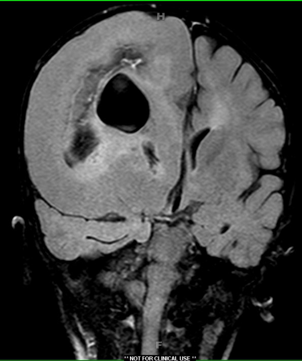 8A1 FCD type II with hemimegalencephaly (Case 9) FLAIR 1 - Copy