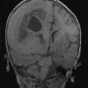 8A2 FCD type II with hemimegalencephaly (Case 9) MPRAGE no contrast 1 - Copy