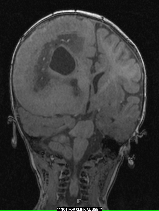 8A2 FCD type II with hemimegalencephaly (Case 9) MPRAGE no contrast 1 - Copy