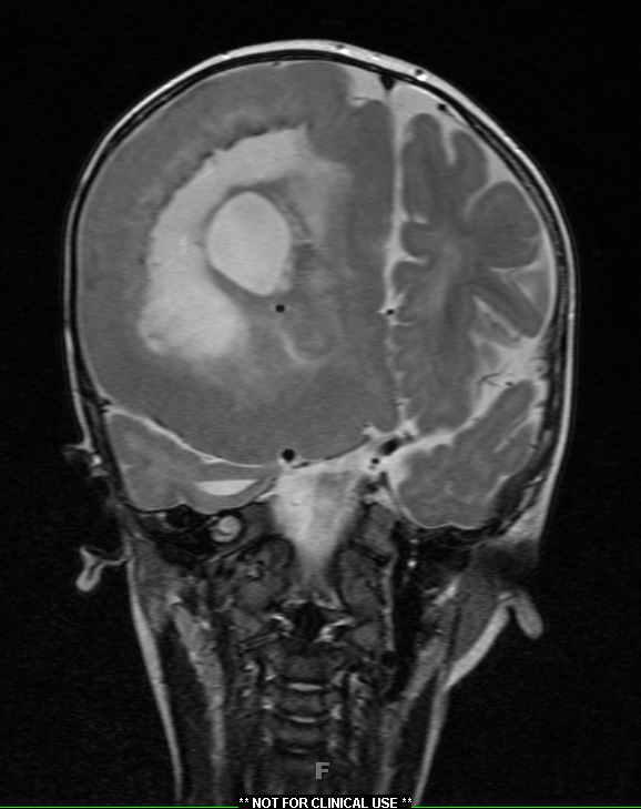 8A3 FCD type II with hemimegalencephaly (Case 9) T2 with contrast - Copy