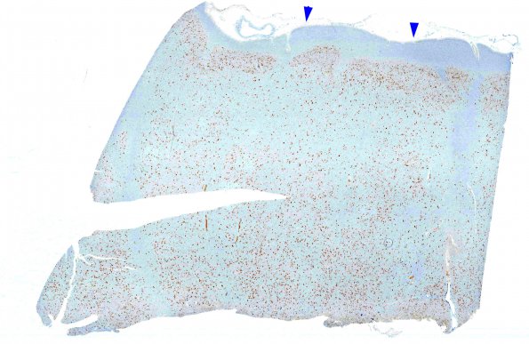 8C1 FCD, type IIA (Case 9) NeuN whole mount copy