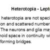 0A Heterotopia - Leptomeningeal Text