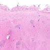 3A1 Heterotopia, leptomeningeal (Case 3) H&E 5