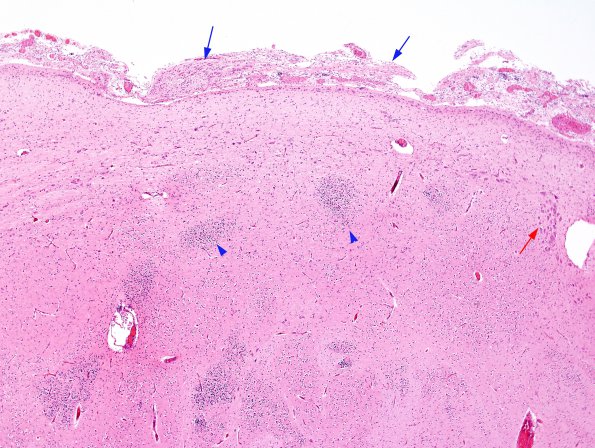 3A1 Heterotopia, leptomeningeal (Case 3) H&E 5