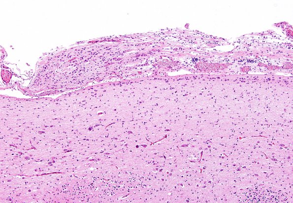 3A2 Heterotopia, leptomeningeal (Case 3) H&E 6