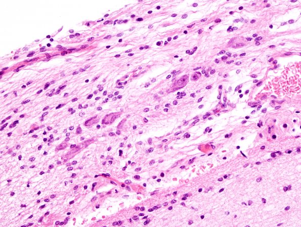 3A3 Heterotopia, cerebrum (Case 3) H&E 2A