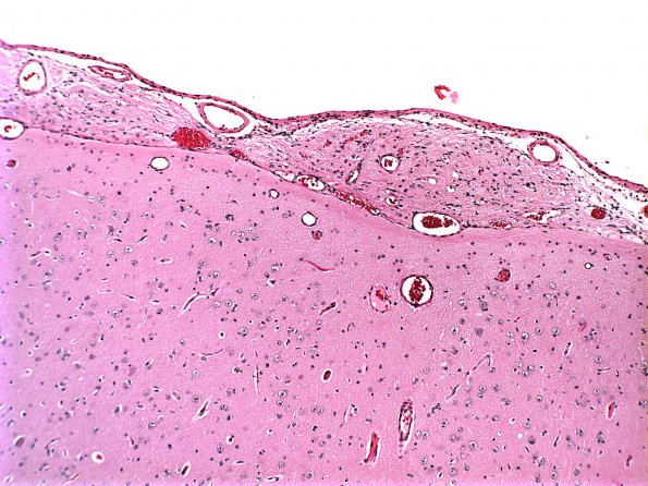 4 Heterotopia Leptomeningeal Glioneuronal (Case 4)