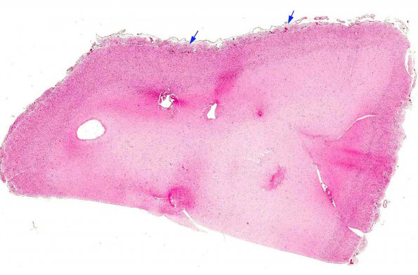 5A1 Heterotopia, leptomeningeal (Galloway-Mowat Syndrome, AANP 1994, Case 9) H&E X0.5