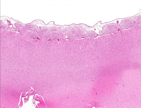 5A2 Heterotopia, leptomeningeal (Galloway-Mowat Syndrome, AANP 1994, Case 9) H&E X2