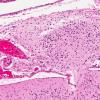 5A3 Heterotopia, leptomeningeal (Galloway-Mowat Syndrome, AANP 1994, Case 9) H&E X15