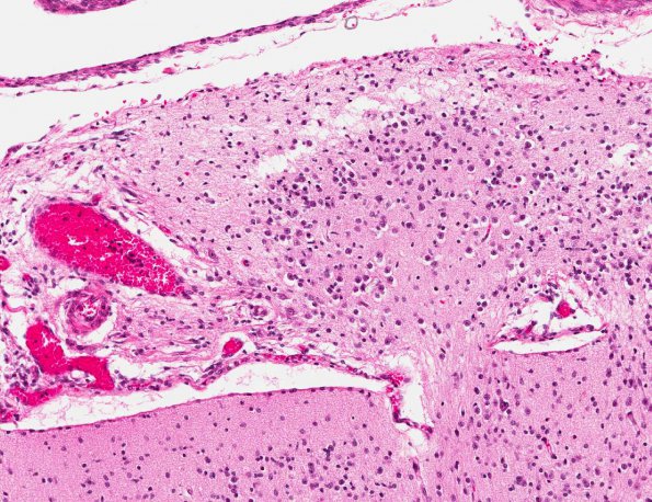 5A3 Heterotopia, leptomeningeal (Galloway-Mowat Syndrome, AANP 1994, Case 9) H&E X15