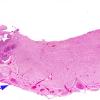 6A1 Heterotopia, leptomeningeal with muscle differentiation (AANP 1980, Case 1) H&E X0.5 2