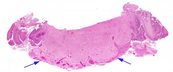 6A1 Heterotopia, leptomeningeal with muscle differentiation (AANP 1980, Case 1) H&E X0.5 2