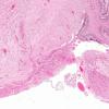 6A2 Heterotopia, leptomeningeal with muscle differentiation (AANP 1980, Case 1) H&E X2 2