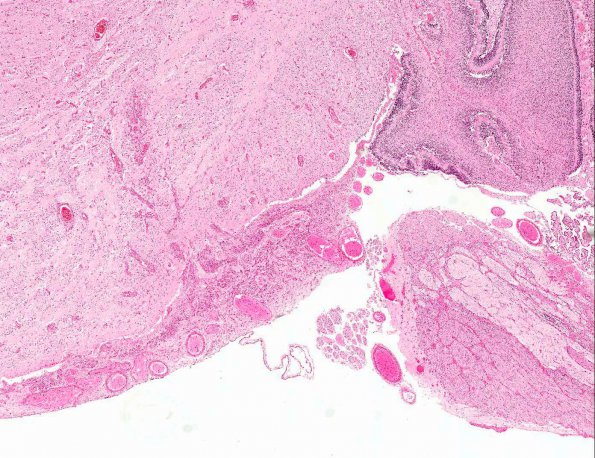 6A2 Heterotopia, leptomeningeal with muscle differentiation (AANP 1980, Case 1) H&E X2 2