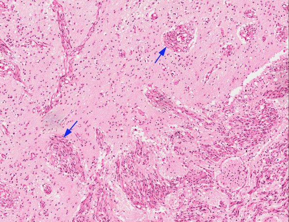 6A3 Heterotopia, leptomeningeal with muscle differentiation (AANP 1980, Case 1) H&E X10 4