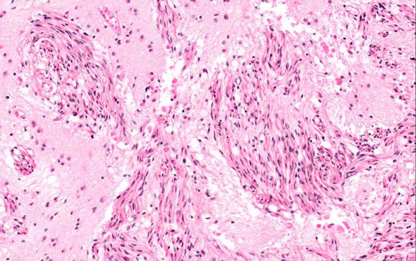 6A4 Heterotopia, leptomeningeal with muscle differentiation (AANP 1980, Case 1) H&E X20 4