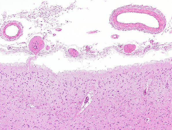 7 Heterotopia, Glioneuronal leptomeningeal (Case 7) H&E 3