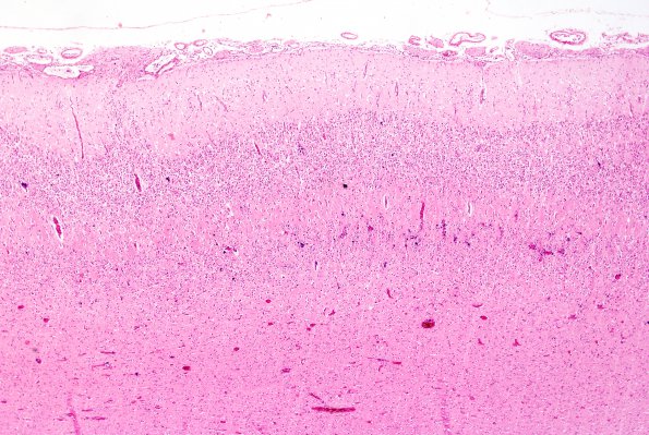 8A1 Holoprosencephaly & Glial Leptomeningeal Heterotopia (Case 8) H&E 8