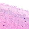 8A2 Holoprosencephaly & Glial Leptomeningeal Heterotopia (Case 8) H&E 4A