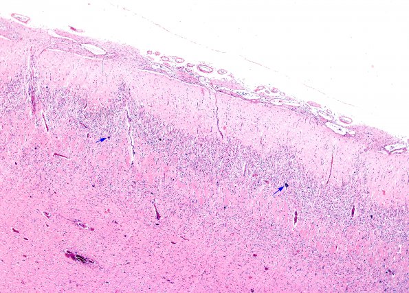 8A2 Holoprosencephaly & Glial Leptomeningeal Heterotopia (Case 8) H&E 4A