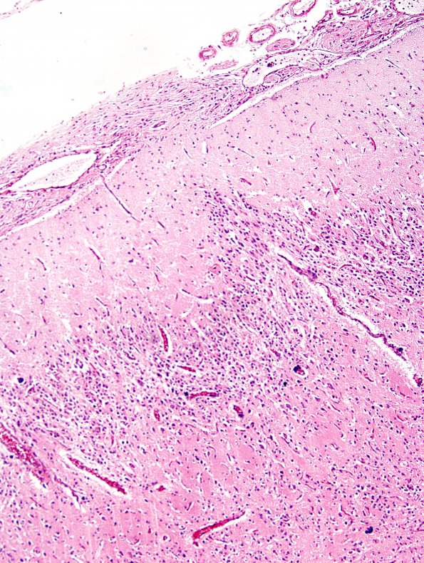 8A3 Holoprosencephaly & Glial Leptomeningeal Heterotopia (Case 8) H&E 6A