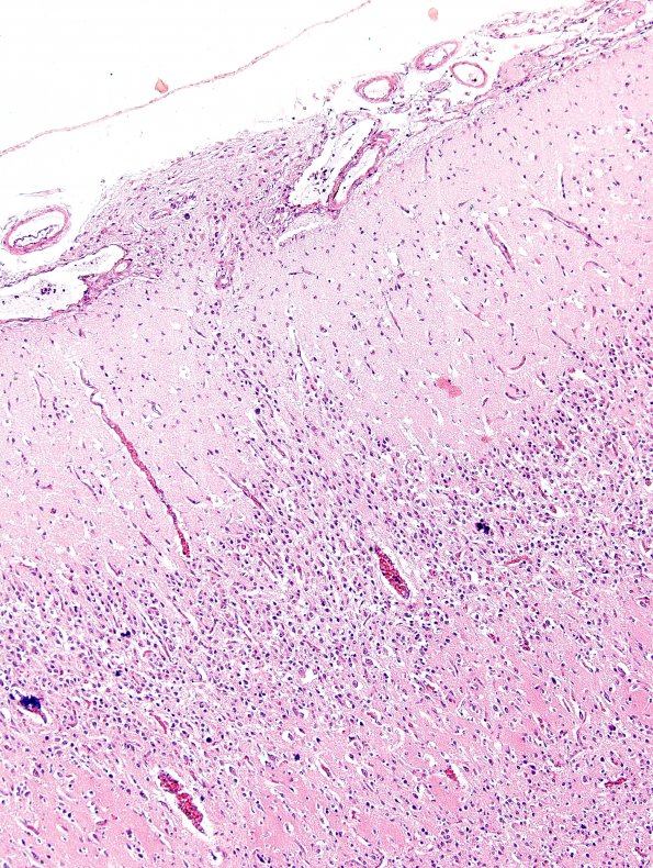 8A4 Holoprosencephaly & Glial Leptomeningeal Heterotopia (Case 8) H&E 5