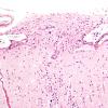 8A5 Holoprosencephaly & Glial Leptomeningeal Heterotopia (Case 8) H&E 3