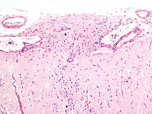 8A5 Holoprosencephaly & Glial Leptomeningeal Heterotopia (Case 8) H&E 3