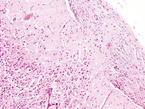 8A6 Holoprosencephaly & Glial Leptomeningeal Heterotopia (Case 8) H&E 7