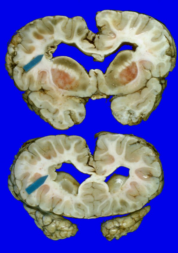 11A1 Heterotopia &  (Case 11) 1A