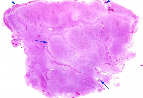 12A1 Heterotopia, subcortical (Case 14) H&E 2 copy