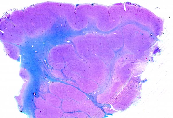 12B1 Heterotopia, subcortical (Case 14) LFB-PAS 1