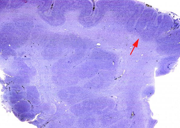 12B2 Heterotopia, subcortical (Case 14) Nissl 1A