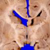 14 Heterotopia, Ventricular (Case 21)aA