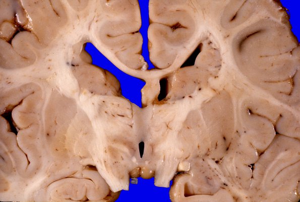 14 Heterotopia, Ventricular (Case 21)aA