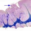 15 Heterotopia and Polymicrogyria (Case 17)