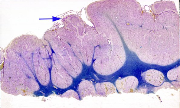 15 Heterotopia and Polymicrogyria (Case 17)