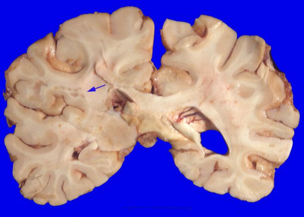 16A1 Heterotopias (Case 19) 1A