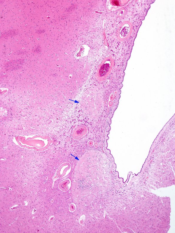 17A1 Heterotopias, incidental, basal ganglia (Case 23) N2 H&E 1 copy