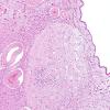 17A2 Heterotopias, incidental, basal ganglia (Case 23) N2 H&E 2