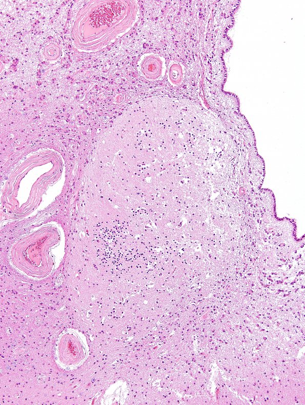 17A2 Heterotopias, incidental, basal ganglia (Case 23) N2 H&E 2